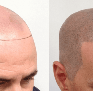 scalp pigmentation