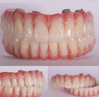 a dental implant model