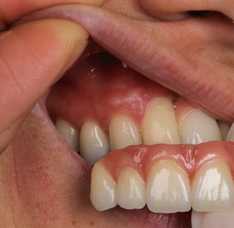 a person trying on dental implant models