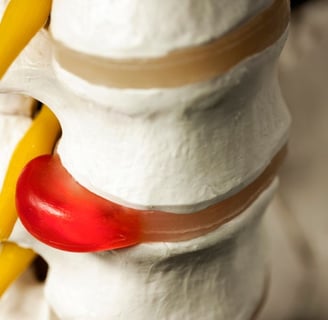 photo of the vertebrae in the spine separated by discs. One bulging disc is causing sciatica.