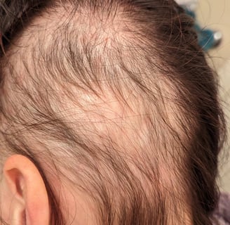 a woman with severe hairloss