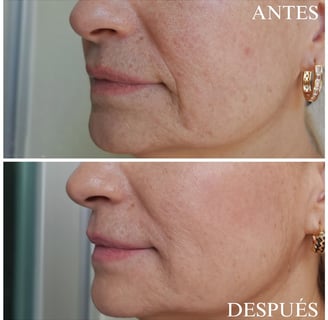 Relleno ácido hialurónico pliegues nasogenianos antes y después