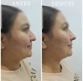 Rinomodelación perfil nariz curva antes y después
