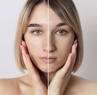 azelaic acid for acne breakouts