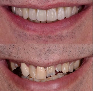 visse de cicatrisation implant