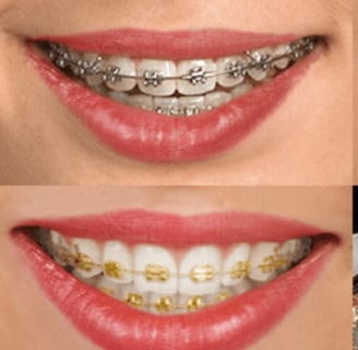 tipos de brackets