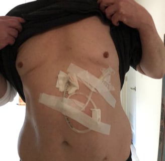 pic of feeding tube
