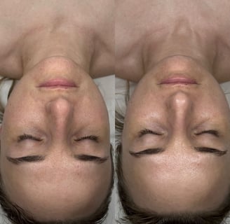 Oxygen Carboxy Therapy – Karboksyterapia