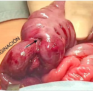 Invaginación intestinal
