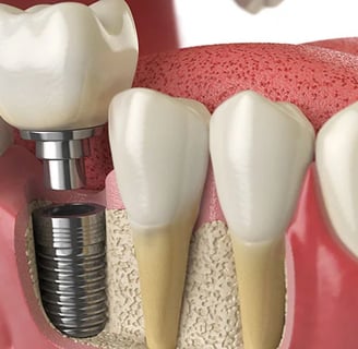 dental implant kolkata