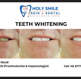teeth whitening treatment at holysmile dental clinic kolkata