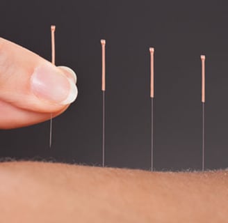 acupuncture