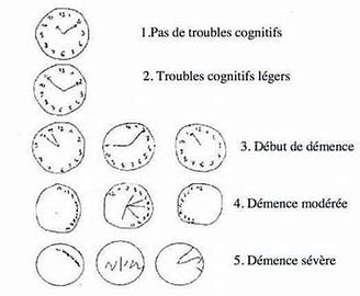 Détections des troubles cognitifs
