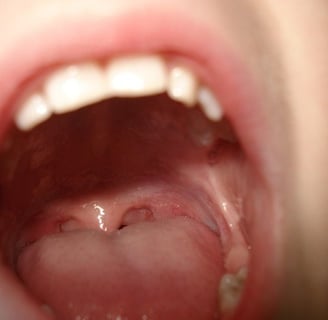 cancer bucal