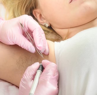 Needle_epilation Electrolysis_hair_removal Electrology