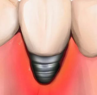 péri-implantite soins jet dentaire ozone aquolab hygiene-precision.com
