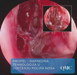 propel-implantat-operacija-sinusa-fess