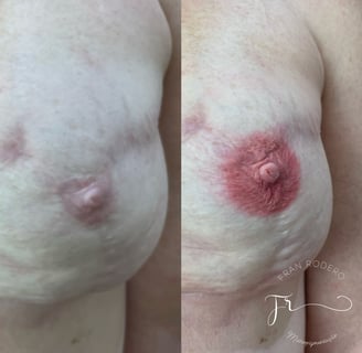reconstrução de cicatriz tatuagem paramédica