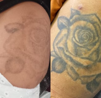 resultado de tratamento de laser para remoção de pigmentos