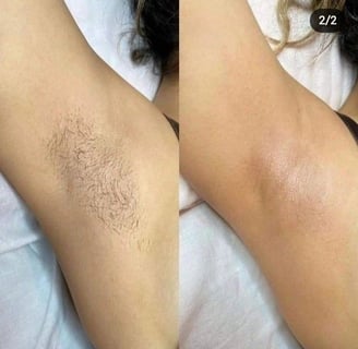 depilacja laserowa pruszków