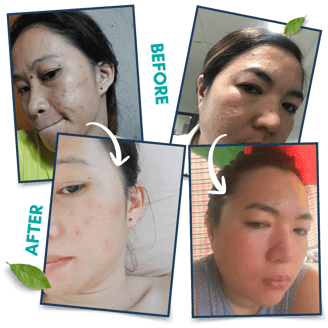 Collage of four images showing side-by-side skincare results after using Allors Skincare products.