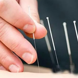Acupuncture