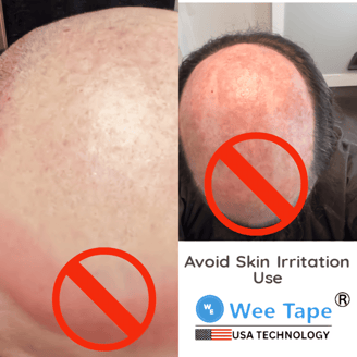 Use weetape hair wig tape to avoid skin iirritation