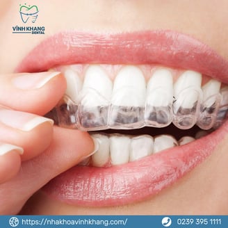 Niềng răng trong suốt