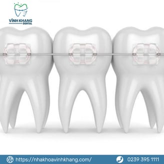 Mắc cài sứ/trong suốt