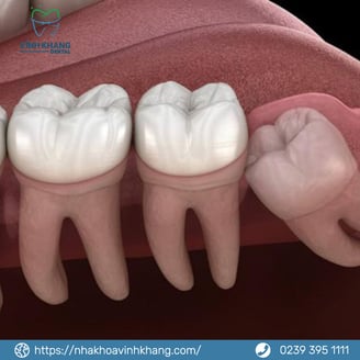 Những Lý Do Chính Để Nhổ Răng Khôn