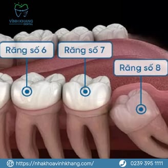Những Lý Do Chính Để Nhổ Răng Khôn