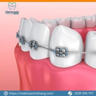 Mắc cài tự động và mắc cài buộc chun có cấu tạo và chức năng gì?