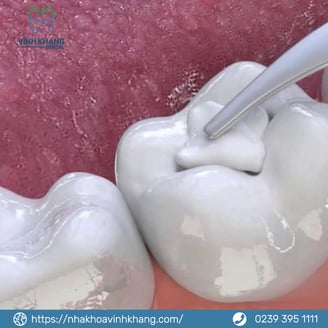 Trám răng sâu an toàn, nhanh chóng tại Nha khoa Vĩnh Khang