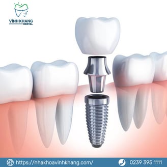 trồng răng Implant
