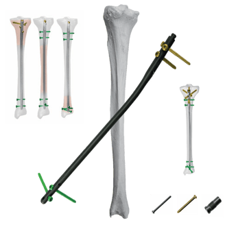 Clavo Intramedular para Tibia
