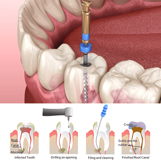 Root Canal Treatment near me |  Ekdantam Dental Clinic kopar khairane