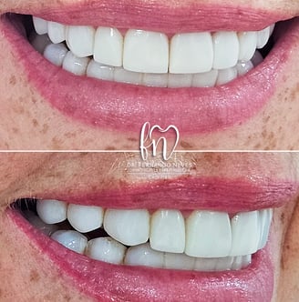 a before and after image of dental treatment