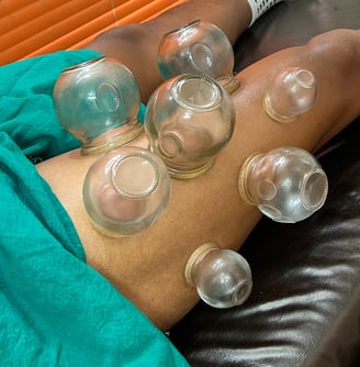 Fire Cupping