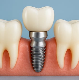 Implants Dentaires à Dentiste Saint Louis Marseille