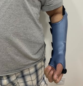 órtese para pós-operatório de fratura de rádio e ulna