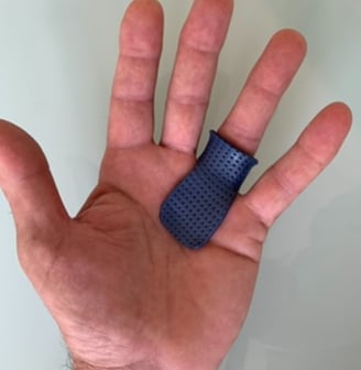 Órtese sob medida para dedo em gatilho com bloqueio da articulação metacarpofalângica