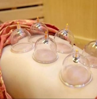 Cupping therapy