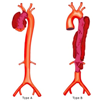 pericardcheck aortic