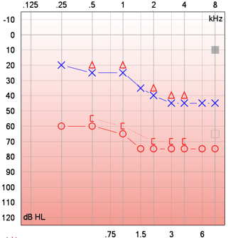 A puretone audiogram showing bilateral asymmetrical loss