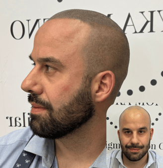 Resultado de micropigmentación capilar en hombre calvo en Madrid, con efecto rapado natural.