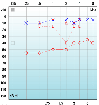 A typical puretone audiogram for otosclerosis