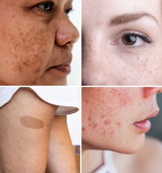 different types of hyperpigmentation singapore