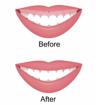 Gummy Smile Correction Treatment in Wadgaon Sheri