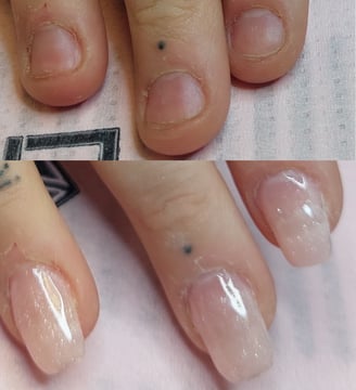 Behandling för nagelbitare