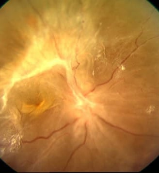 Desprendimiento de retina